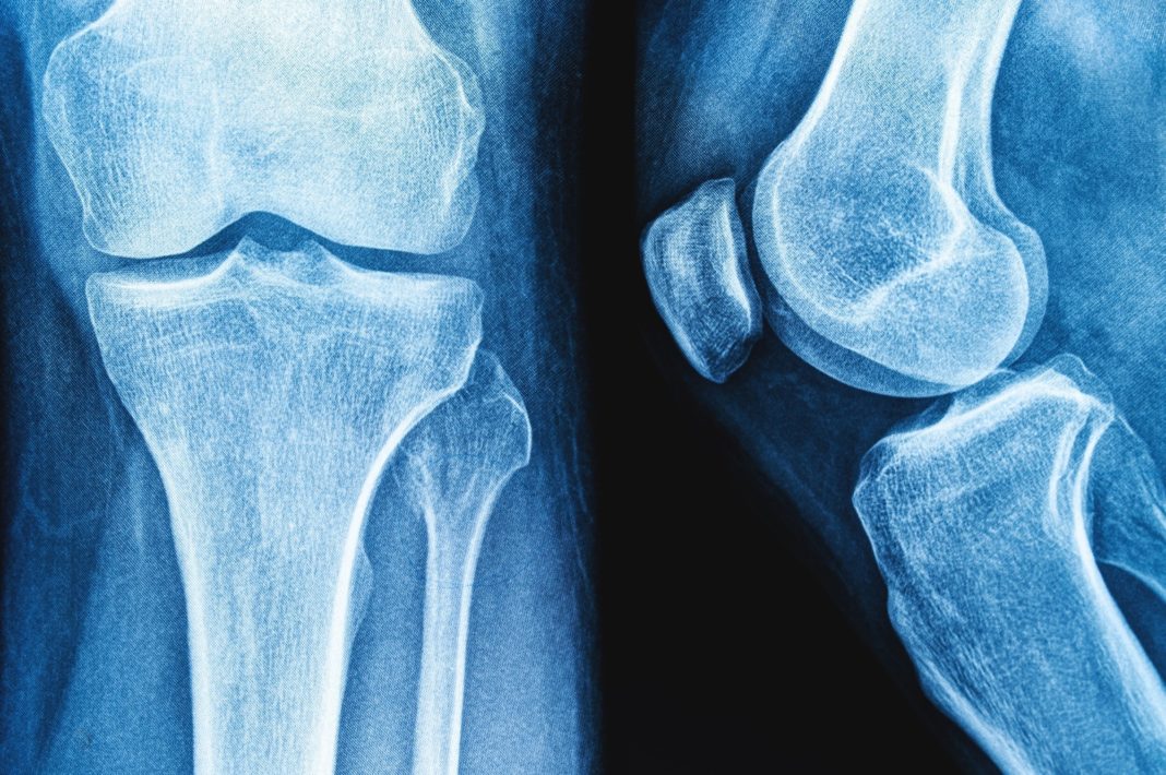 Study: Bone Health After Exercise Alone, GLP-1 Receptor Agonist Treatment, or Combination Treatment. ​​​​​​​Image Credit: siamionau pavel / Shutterstock